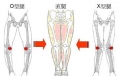 5种走路姿势会让你变成O型腿